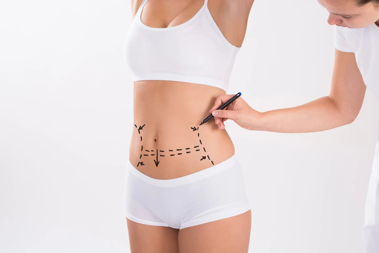 Factors That Influence Liposuction Scarring
