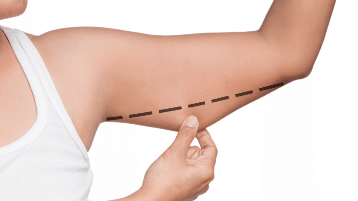 How Arm Liposuction Is Performed: The Procedure Explained