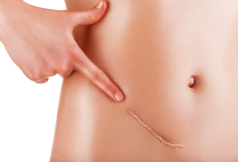 Treatments for Liposuction Scars