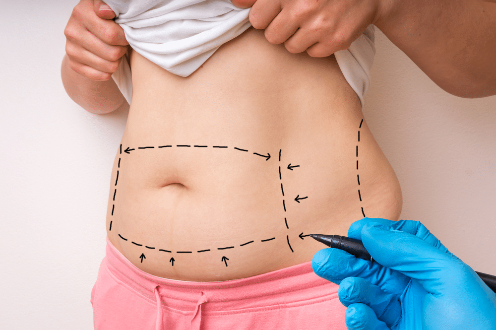 Understanding the Liposuction Procedure
