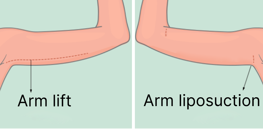 What Is Arm Liposuction and Who Needs It?