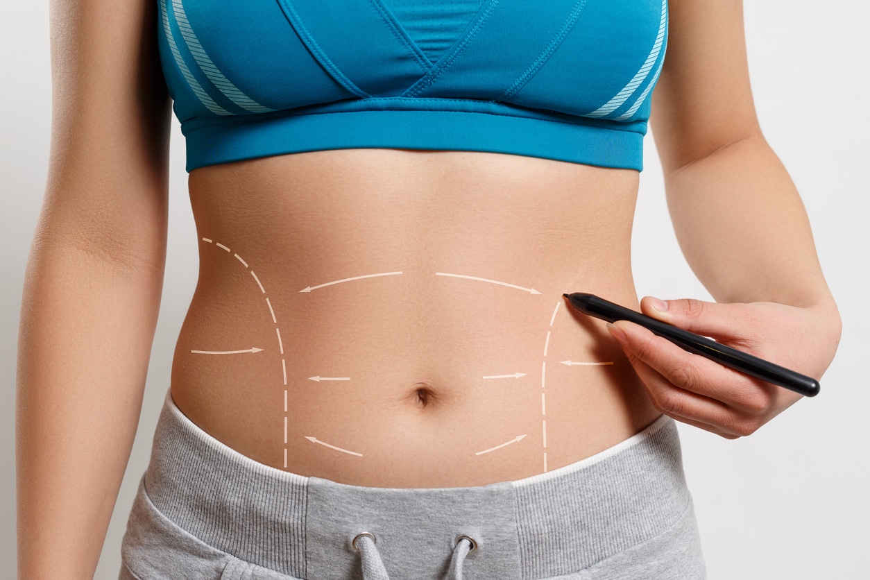 Techniques Used in Belly Button Tummy Tuck