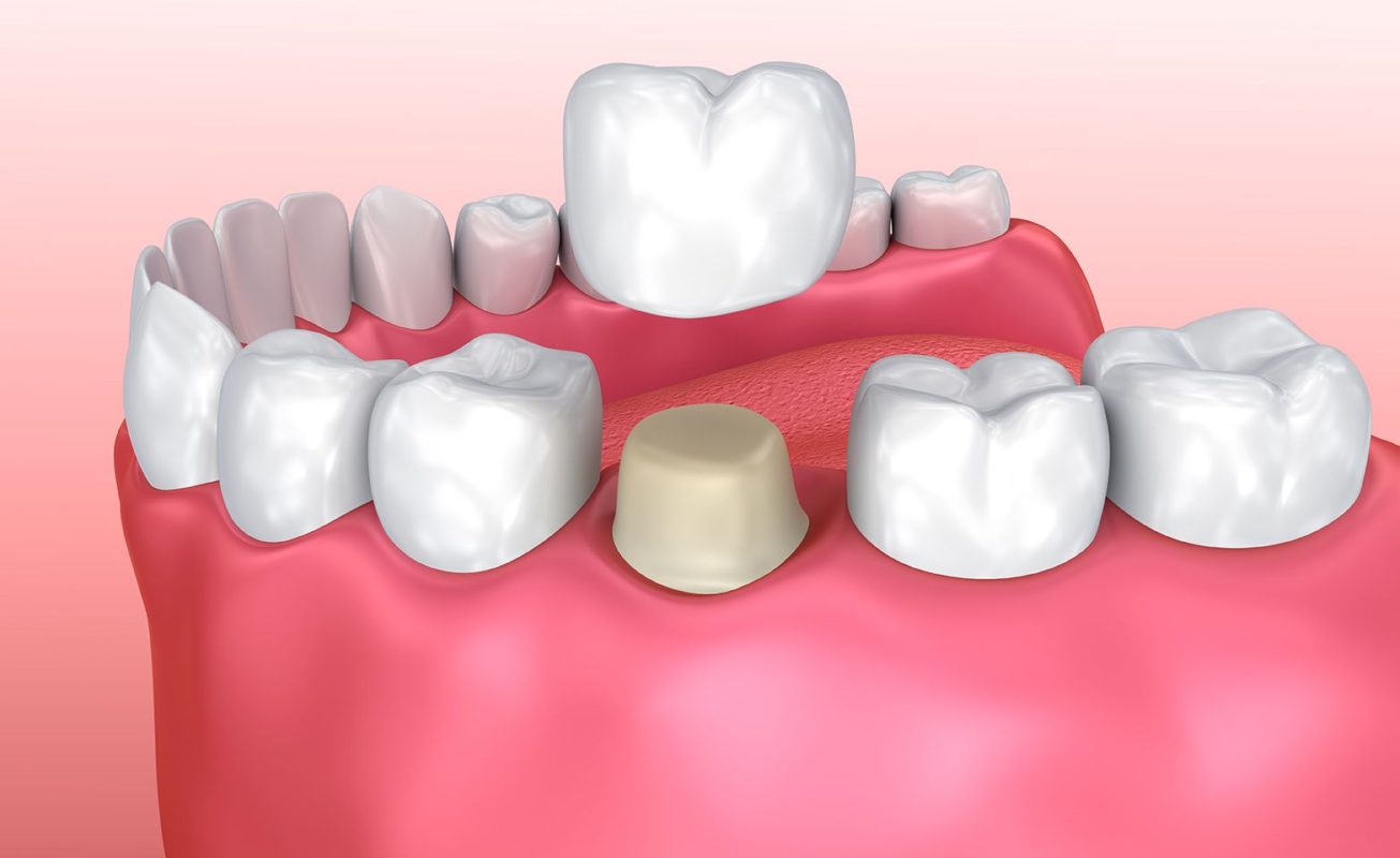 Composition and Durability of Porcelain Crowns