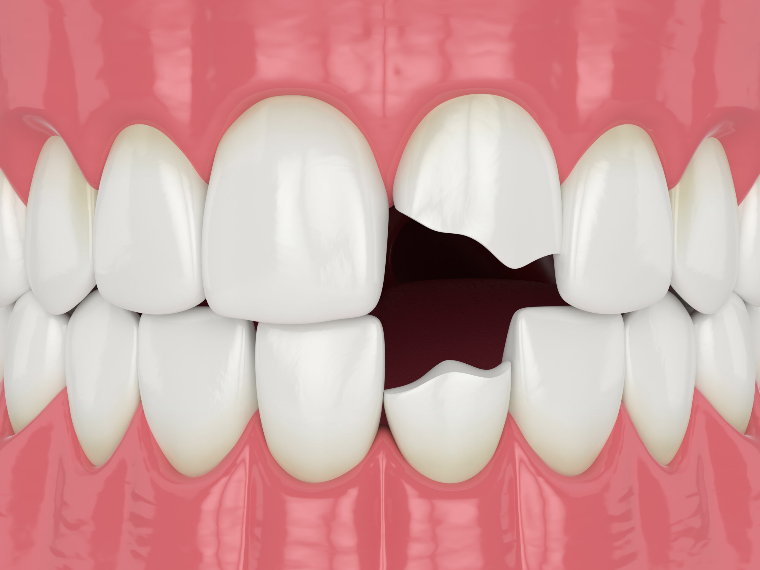 Dental Bonding for Chipped and Cracked Teeth