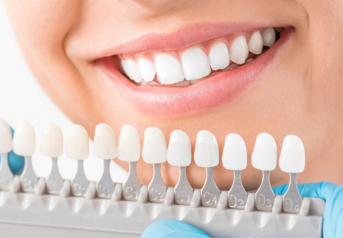 Dental Insurance and Teeth Whitening Coverage