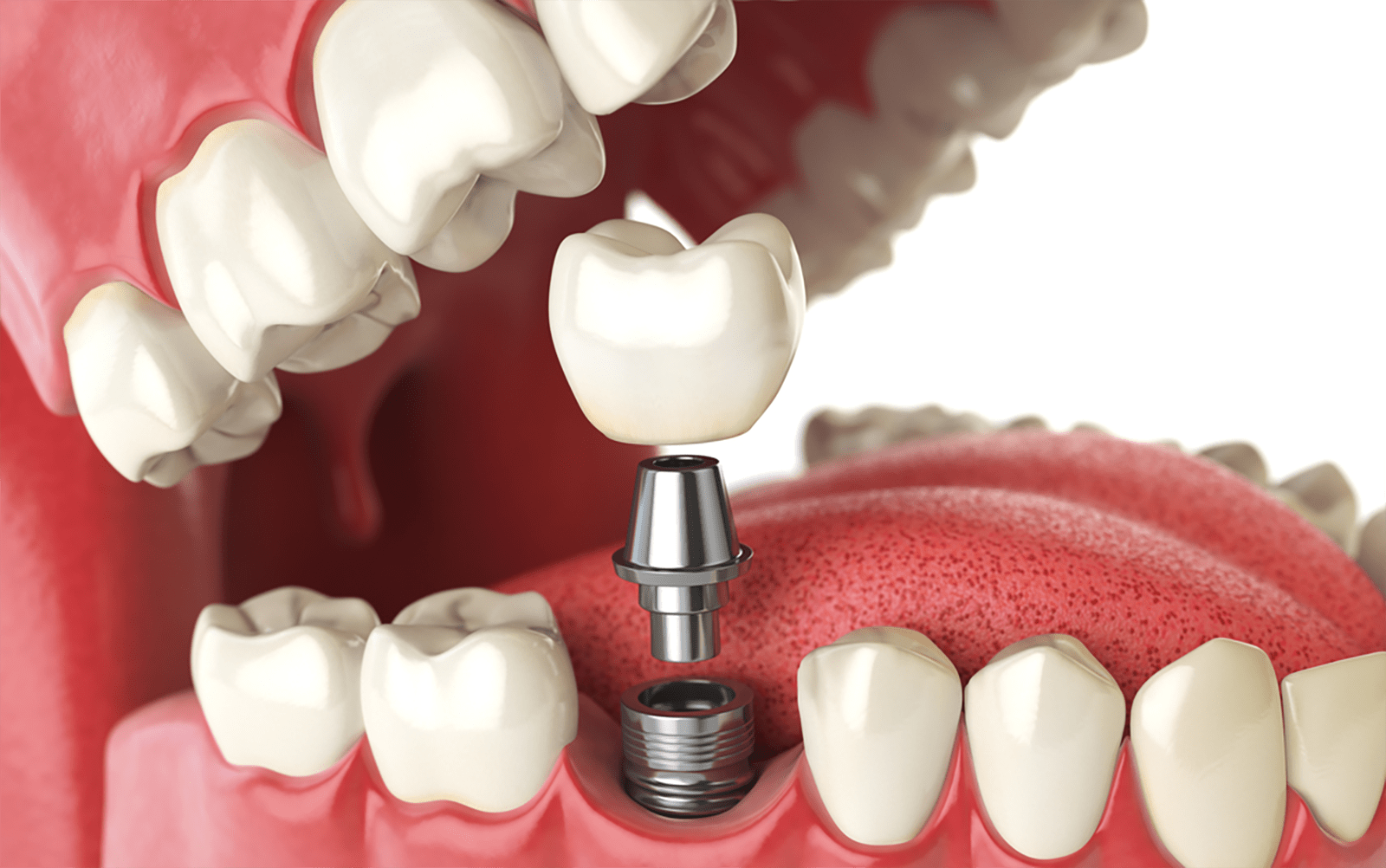 Diagnostic Methods for Detecting Implant Infections