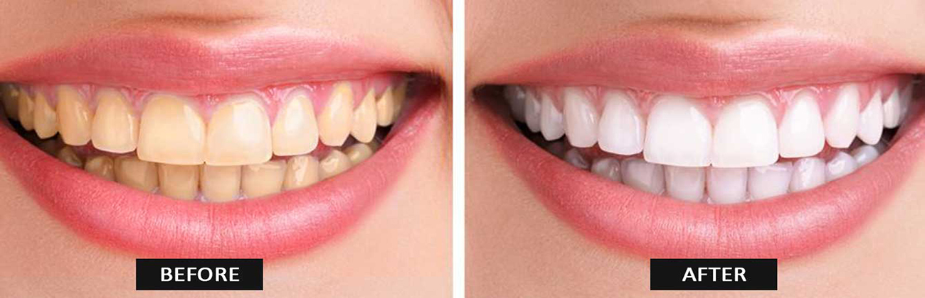 Longevity of Teeth Whitening Results