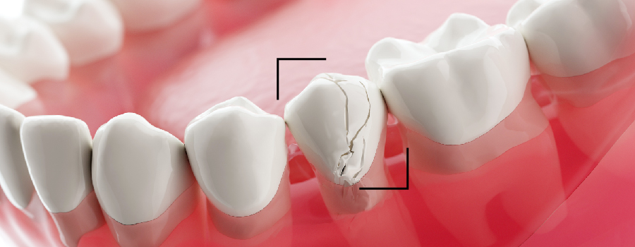 Repairing and Replacing Porcelain Dental Crowns