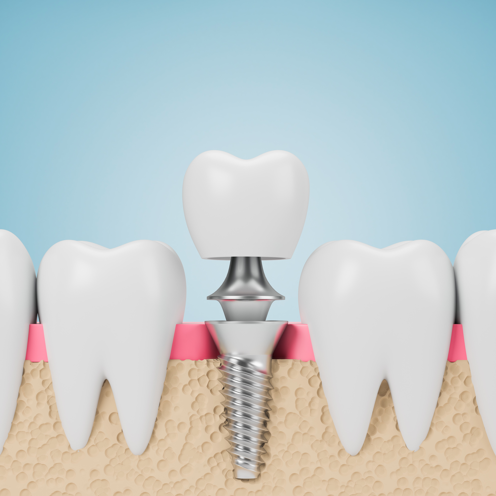 Surgical Treatments for Severe Dental Implant Infections