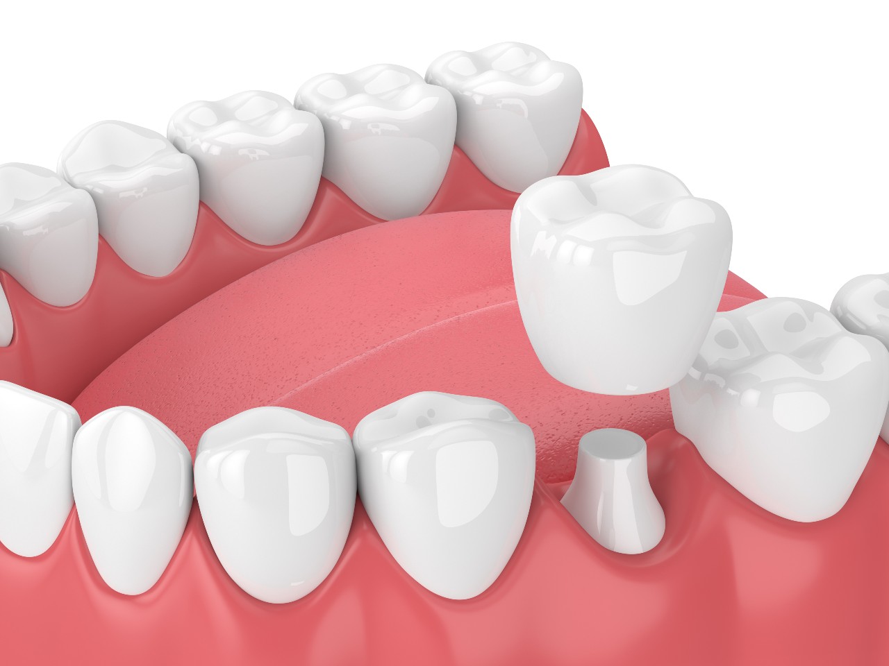 The Lifespan of Porcelain Dental Crowns