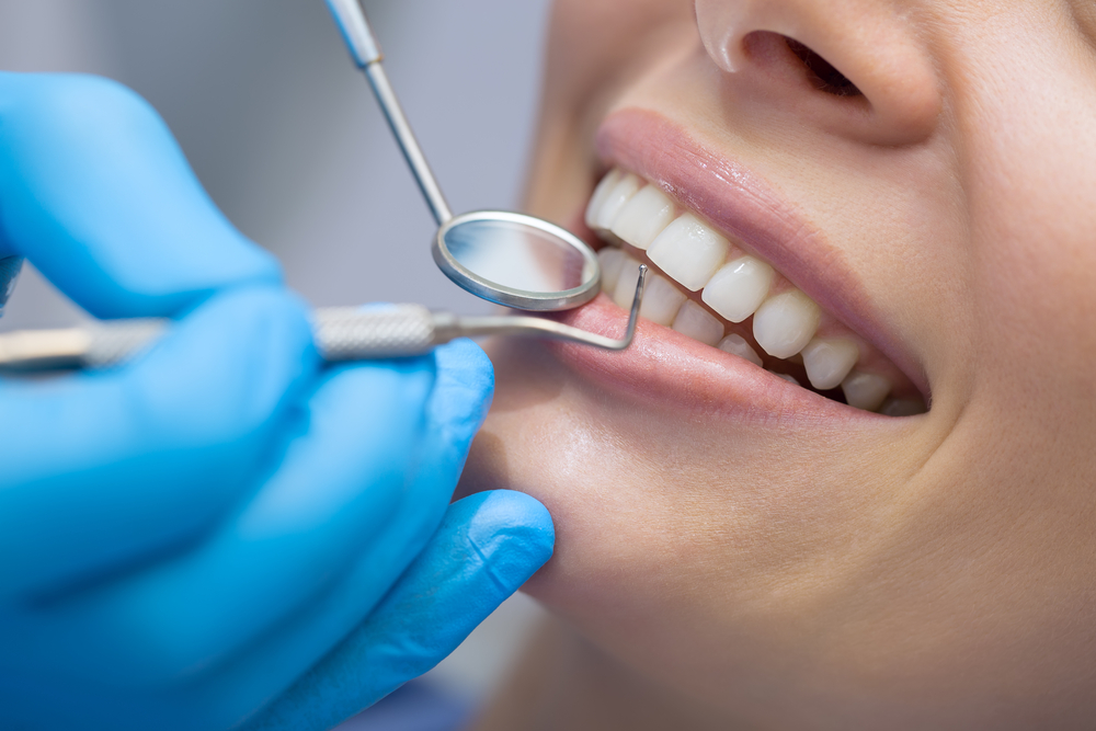 Tooth-Colored Fillings for a Natural Look