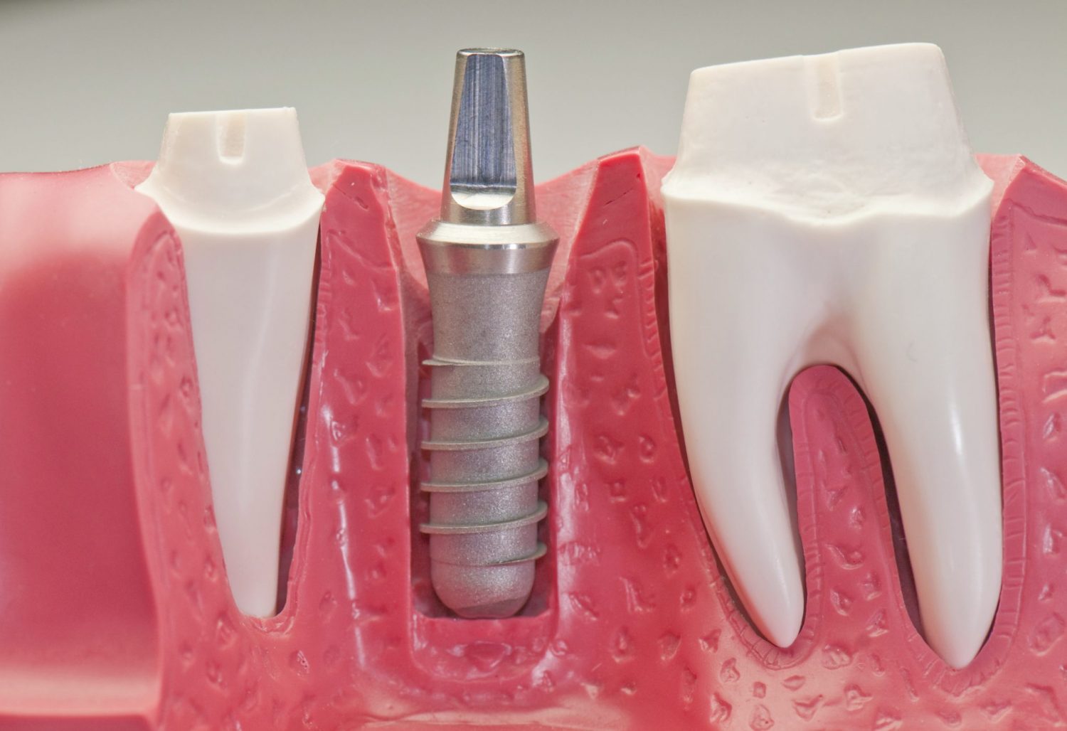 Understanding Dental Implant Infections: Causes and Symptoms