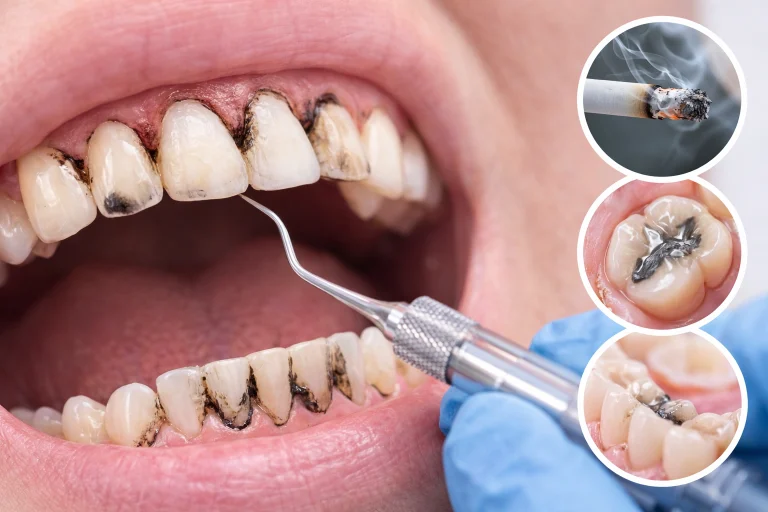 What Are Black Stains on Teeth?