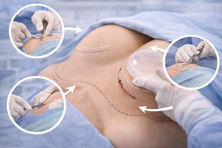 How to Do Breast Enlargement Surgery?